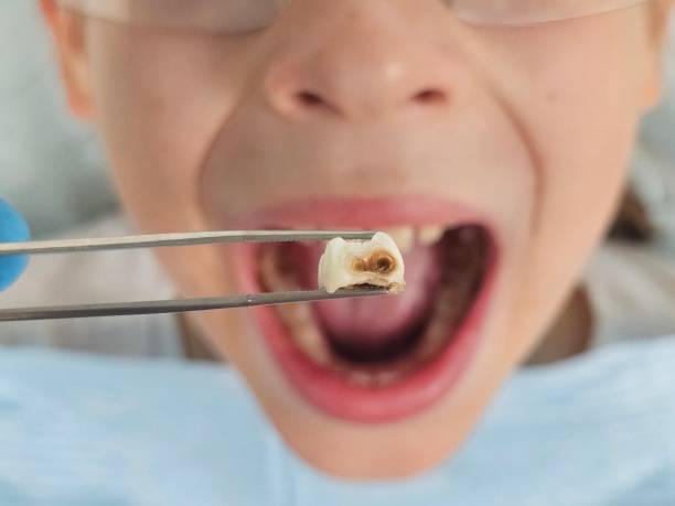 Best Emergency Dental Care for Broken or Chipped Teeth in Swartz, LA